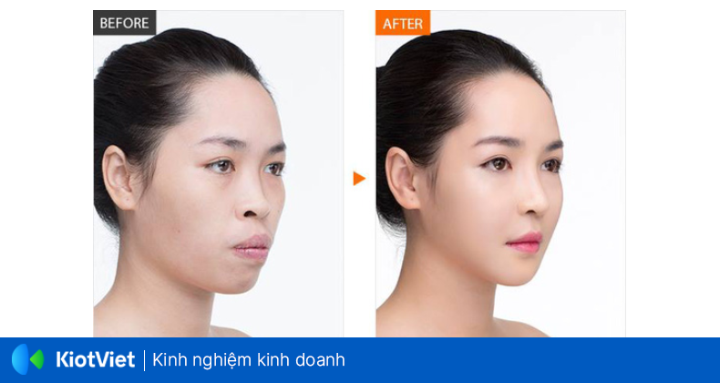 anh before after